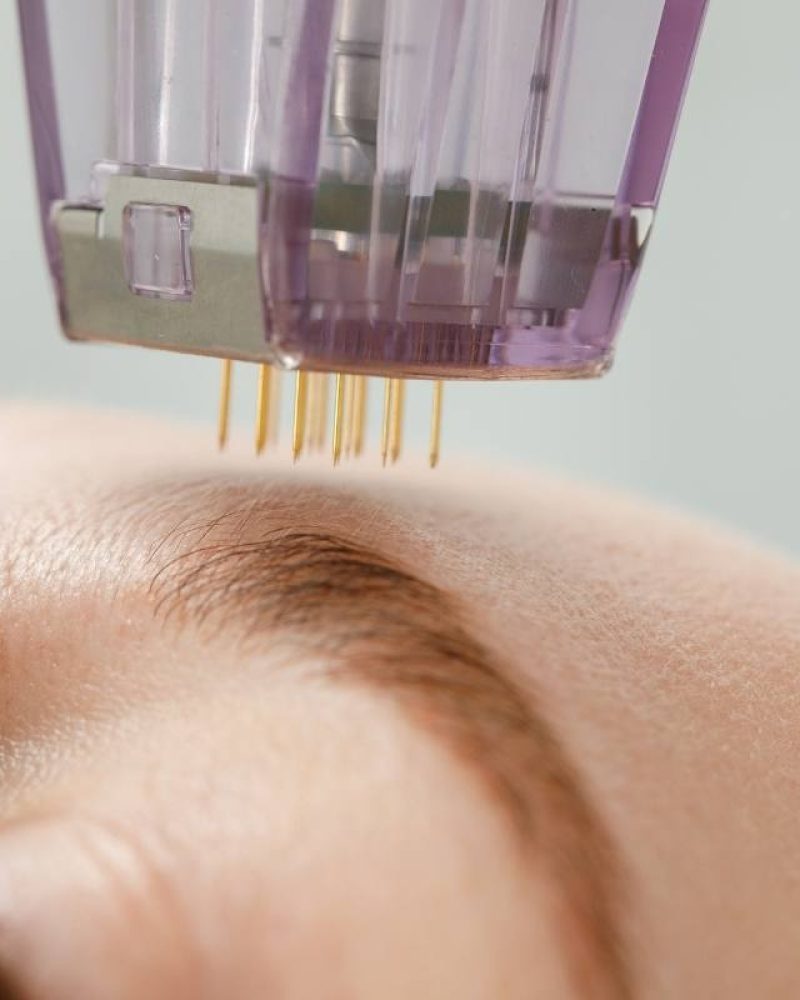 Exosome Therapy with RF Microneedling: Benefits beyond skin clarity