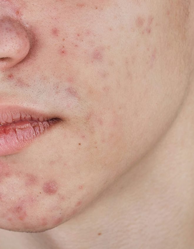 Understanding acne causes and its treatments in Singapore