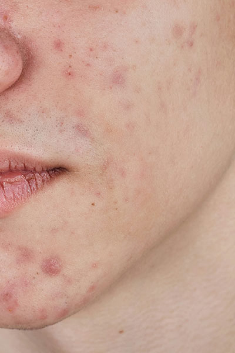 Understanding acne causes and its treatments in Singapore