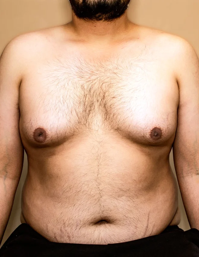 [Podcast] FAQ on Gynecomastia in Singapore