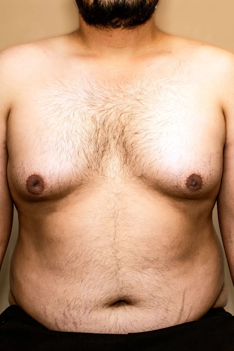 [Podcast] FAQ on Gynecomastia in Singapore