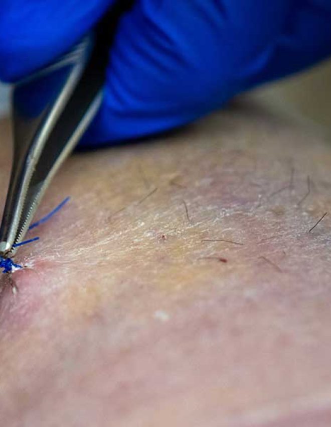 Does the Number of Incisions Matter in Liposuction? Here’s an Honest Answer