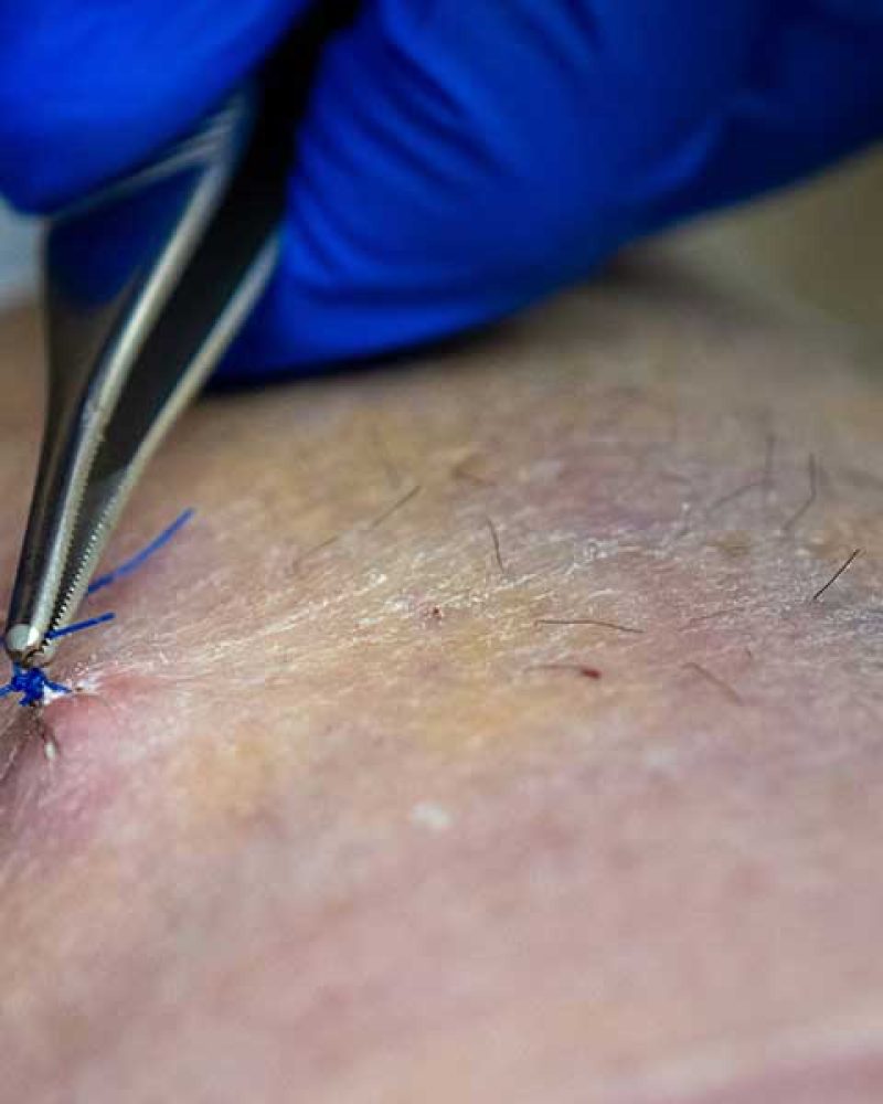 Does the Number of Incisions Matter in Liposuction? Here’s an Honest Answer