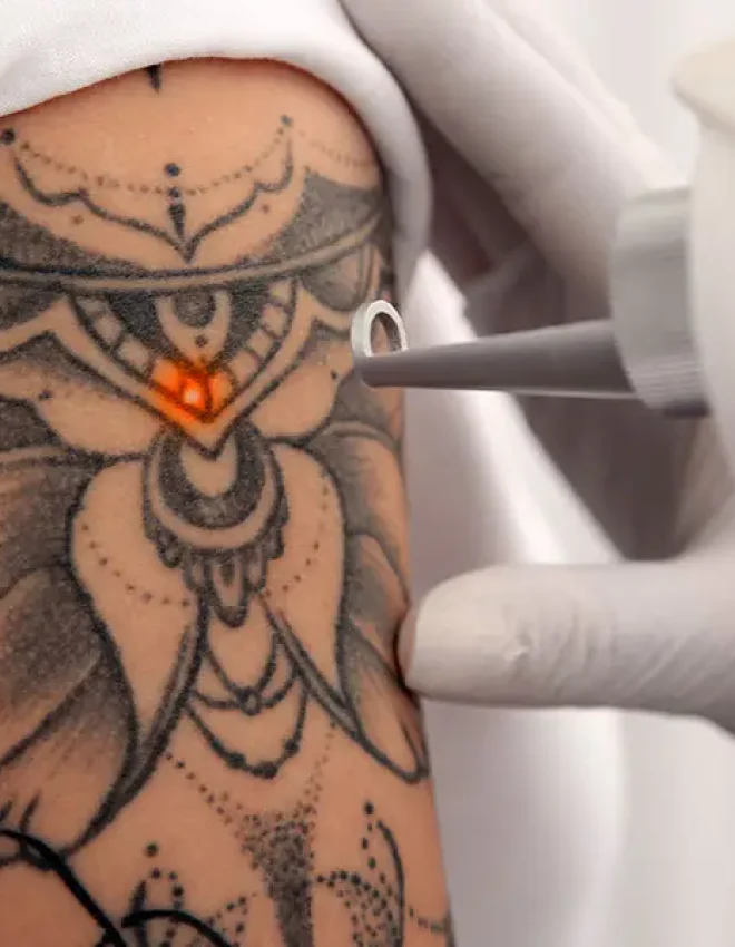 Tattoo Removal FAQs: Doctor Answers from Singapore Podcast