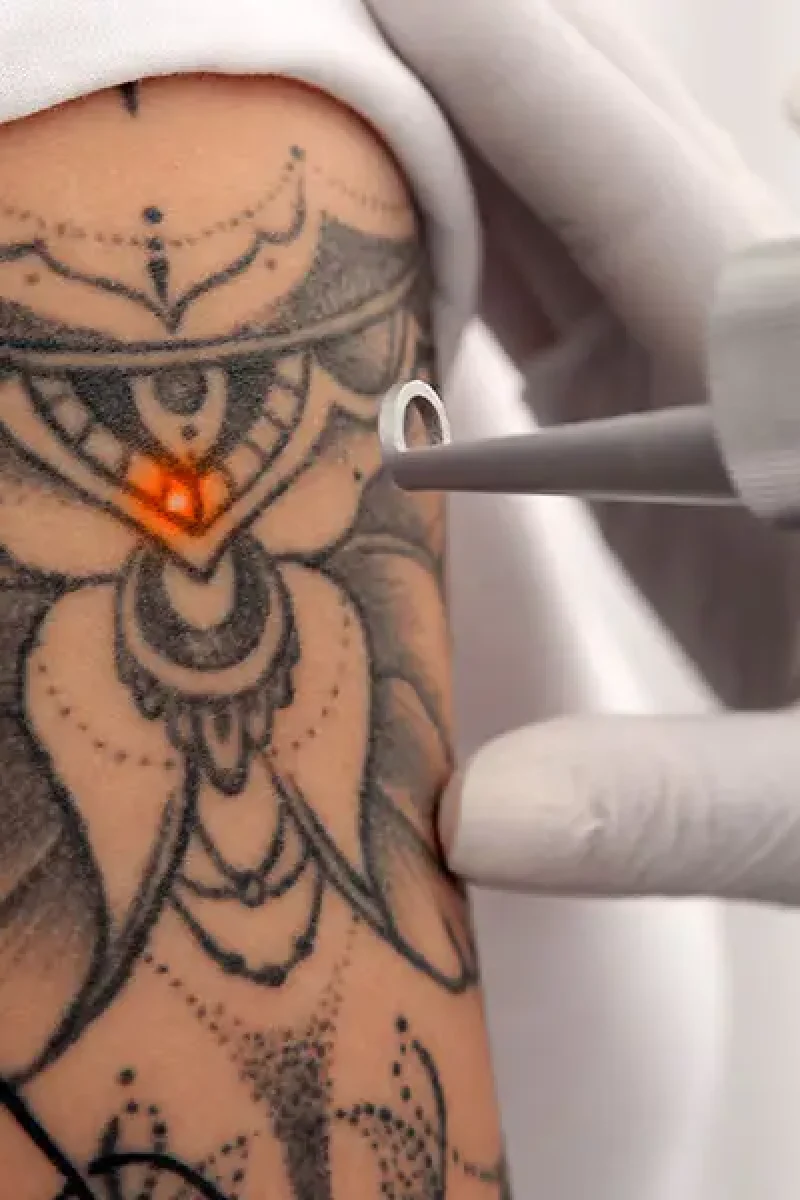 Tattoo Removal FAQs: Doctor Answers from Singapore Podcast